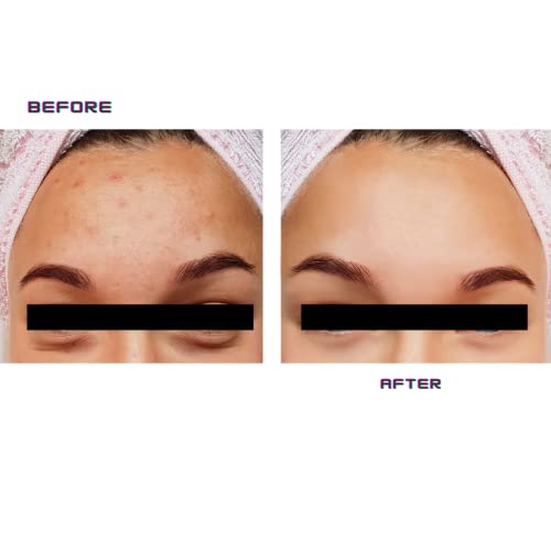 Niacinamid Serum 12% + 2% cink, Serum za lice sa hidratantnom hijaluronskom kiselinom; Refine & Balance Skin + Minimiziraj pore, čista Njega kože koju je testirao dermatolog, tretirajte tamne tačke, poboljšajte neujednačen tonus kože & tekstura, smanjuje Fine linije & bore, 1oz